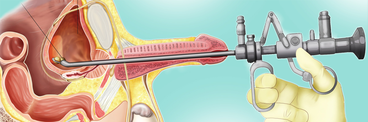 Representación de cistoscopia