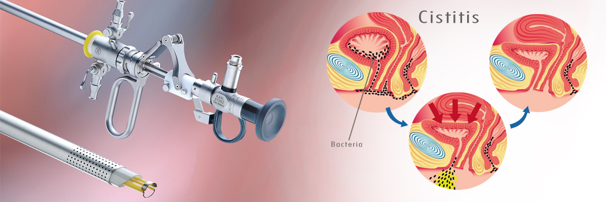 Prueba médica de la vejiga